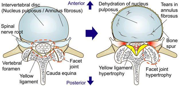 lumbar canal stenosis(1).jpg